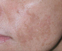 melasma tache visage